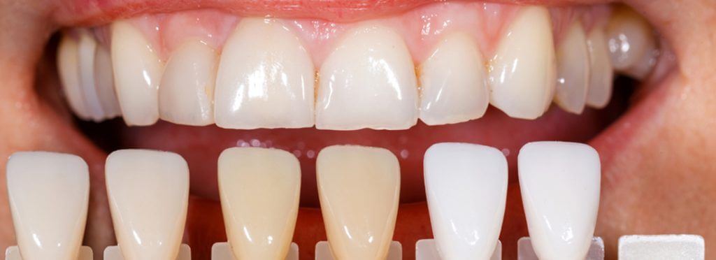 Why Porcelain Veneers are called Instant Orthodontics