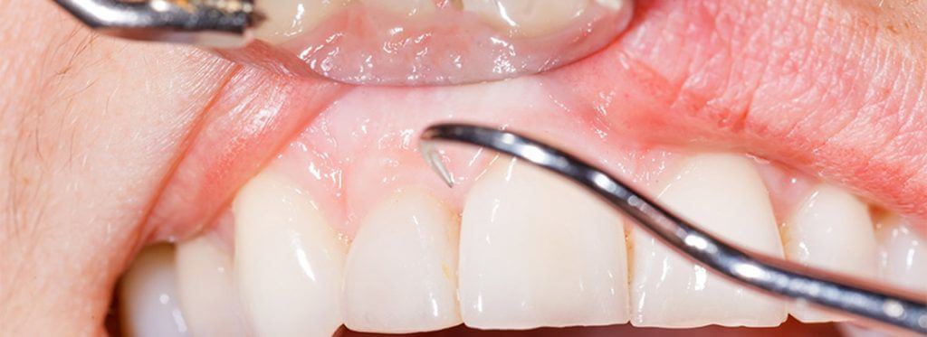 Treatment Options for Gum Disease