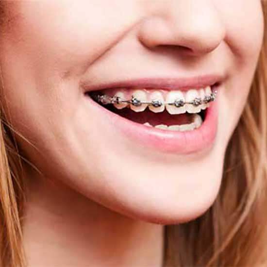 4 Easy Steps To Take Care Of Your Dental Brace