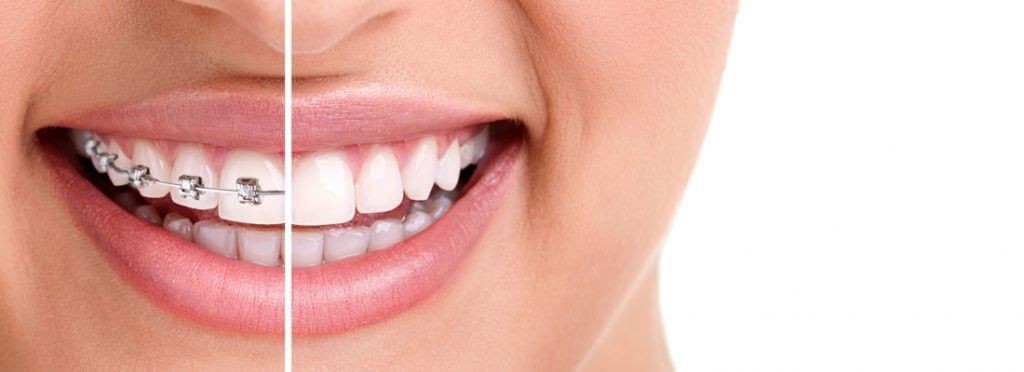 The reasons teeth shift