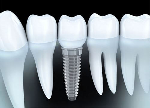 The ultimate guide to dental implants