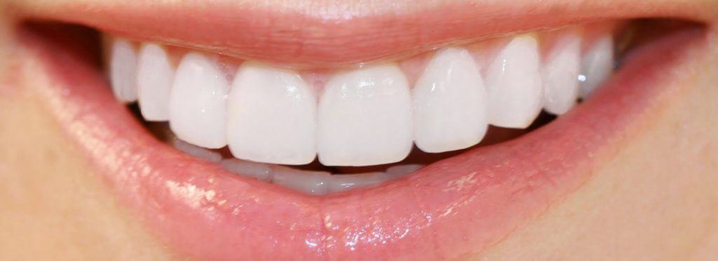 Are Porcelain Veneers right for you