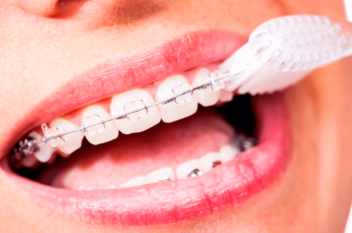 6 Tips To Take Care Of Your Teeth With Braces