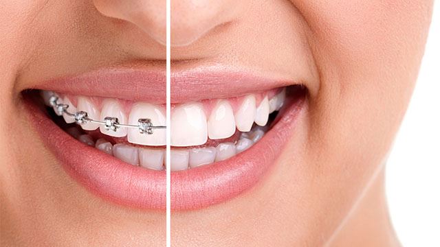 Dental Braces: What Are Benefits of Getting One?