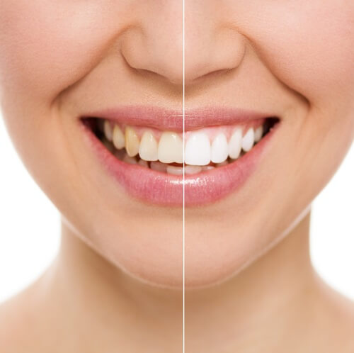 Things You Need To Know Before, During And After Teeth Whitening