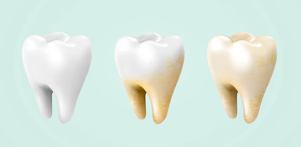 Discover 5 Leading Factors That Lead To Accumulated Stains On Your Teeth