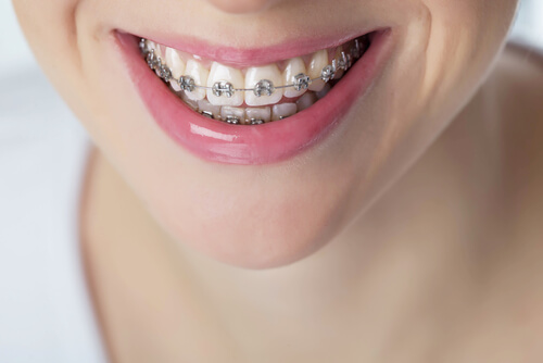 7 Things To Consider Before Getting Adult Braces
