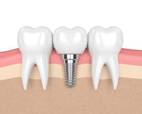 Five Signs You Need Dental Implants