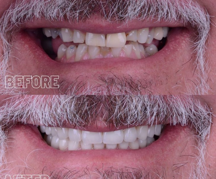Before and after picture of a male patient after the veneer treatment