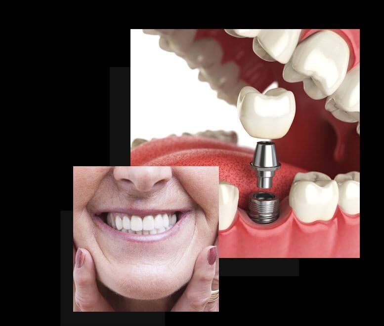 Are You A Good Candidate For Dental Implants?